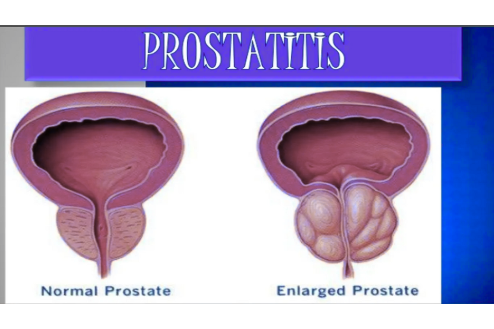 prostatitis