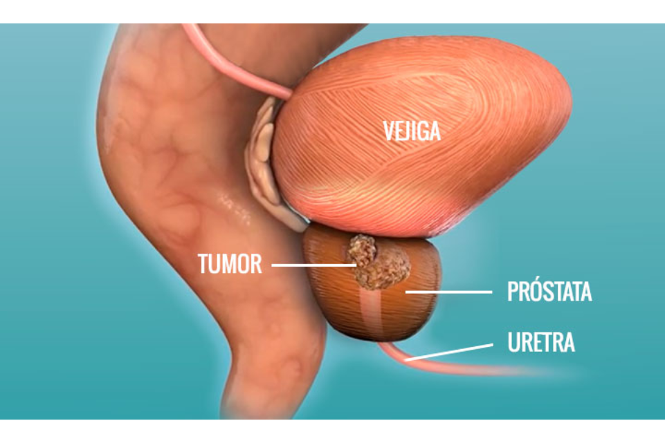 cancer de prostataa